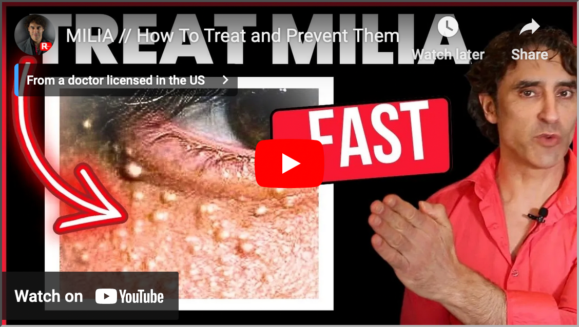 MILIA // How To Treat and Prevent Them
