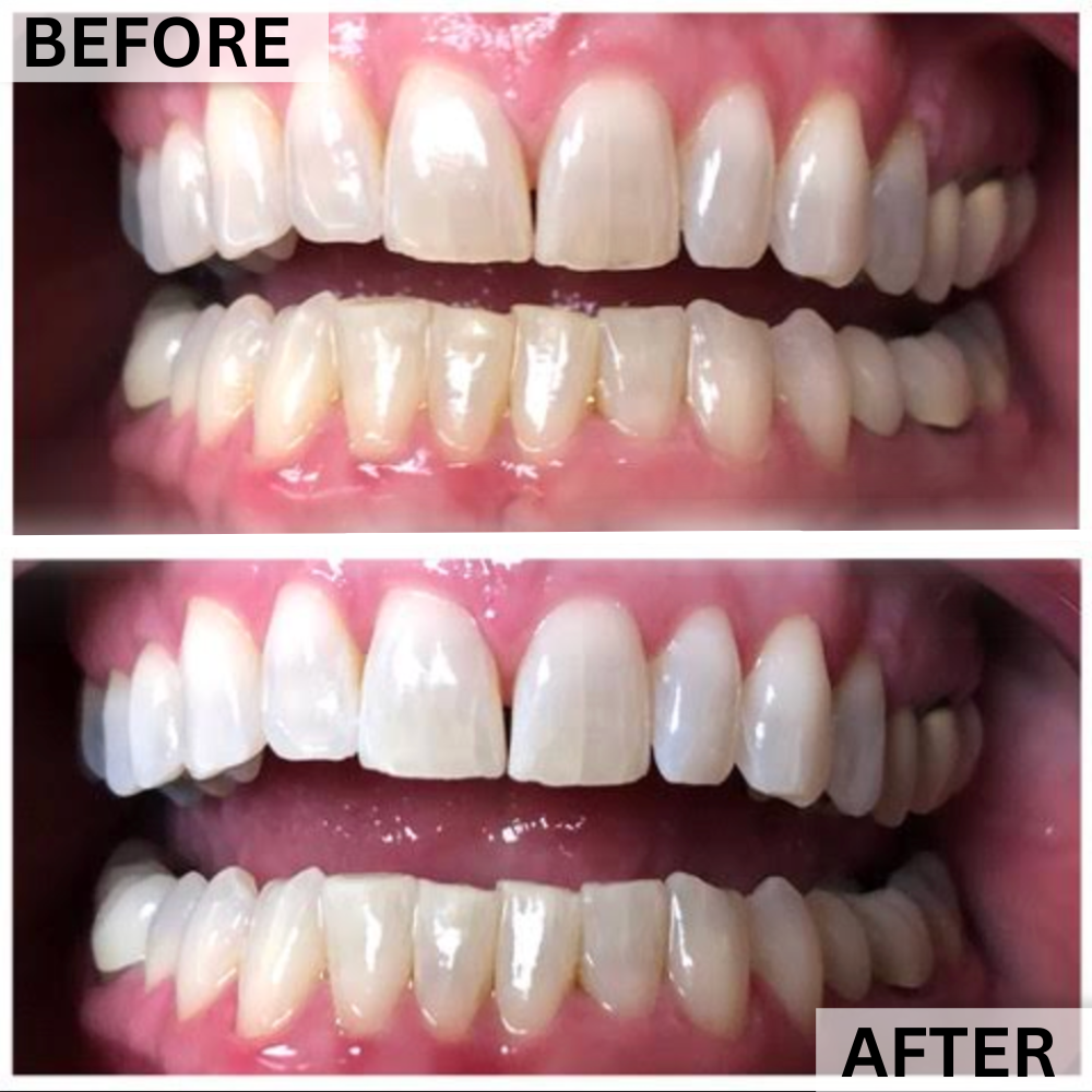 GLOwhite Teeth Whitening Gel