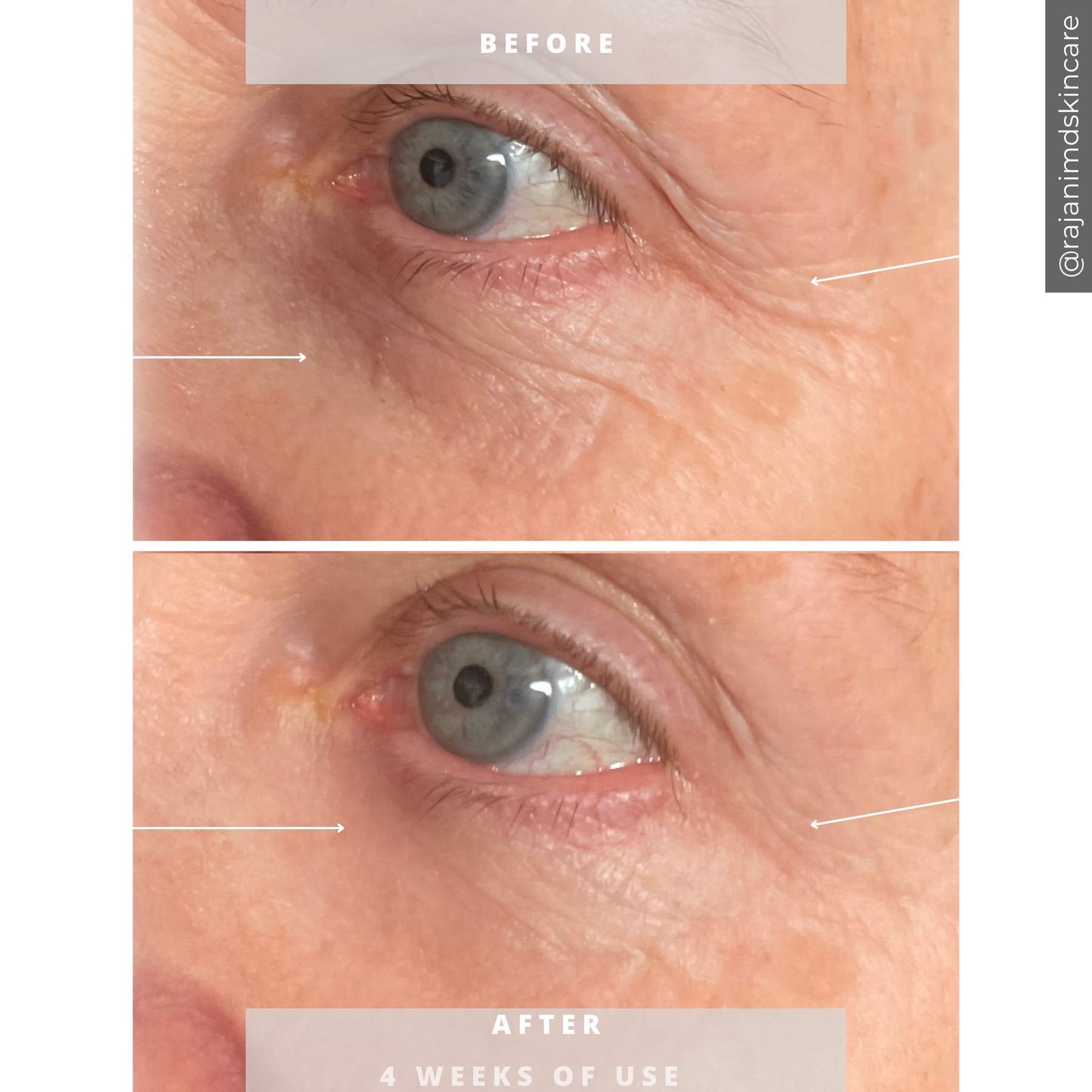 Plasma Restore GLO – Volufiline™ Cream