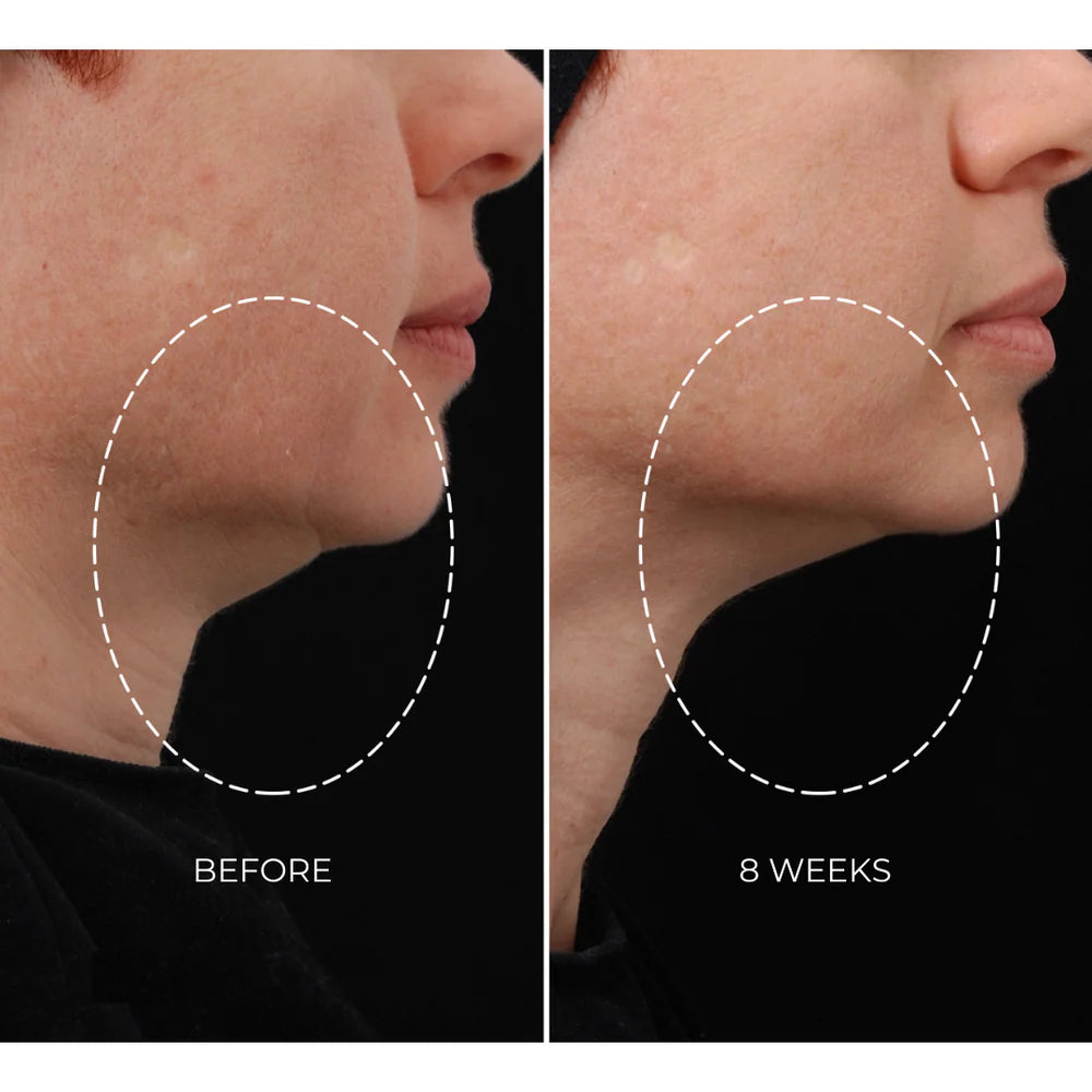 NEWA+ Cordless RF Wrinkle Reduction Device (Pink)