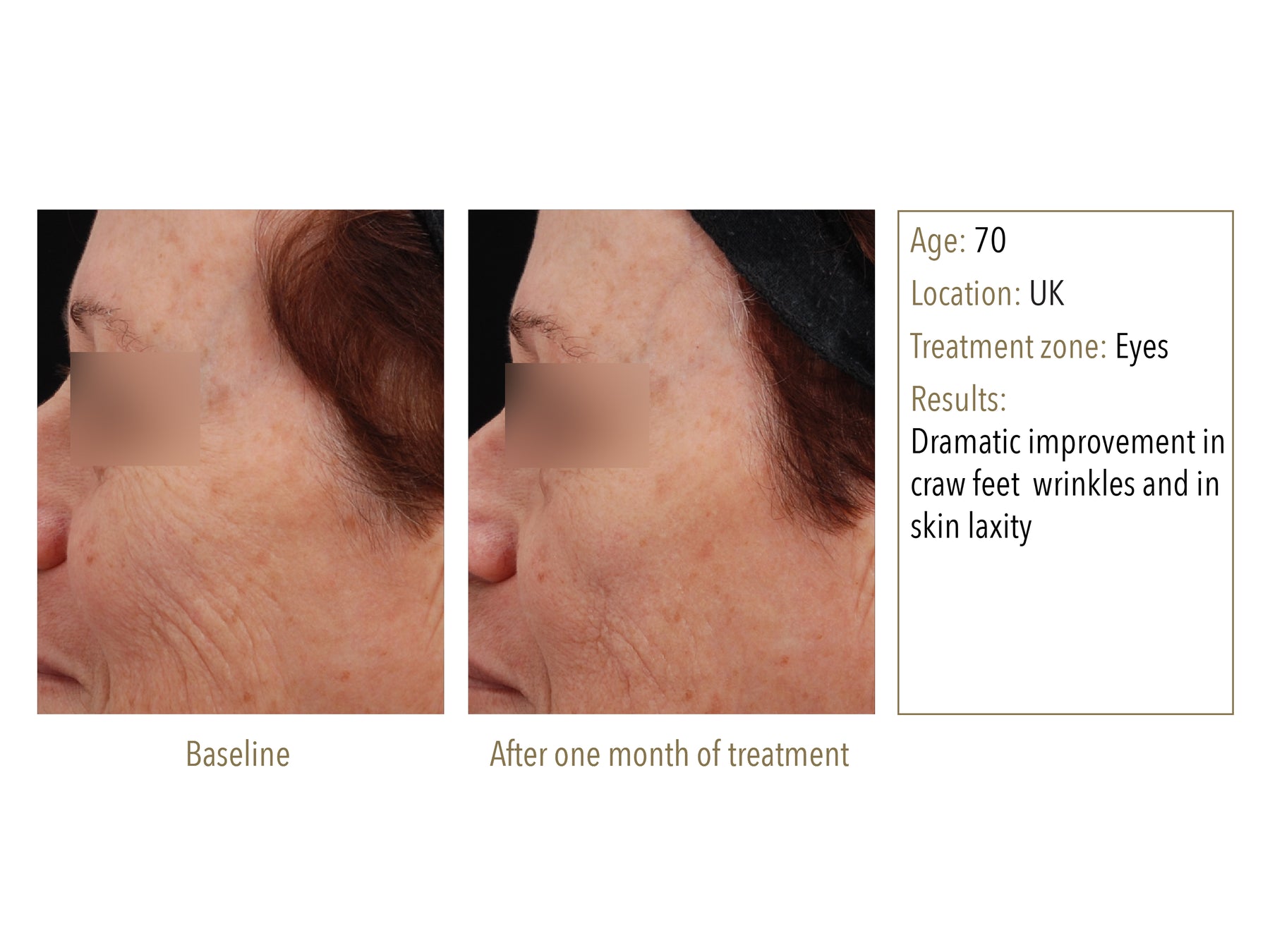 NEWA+ Cordless RF Wrinkle Reduction Device (Pink)