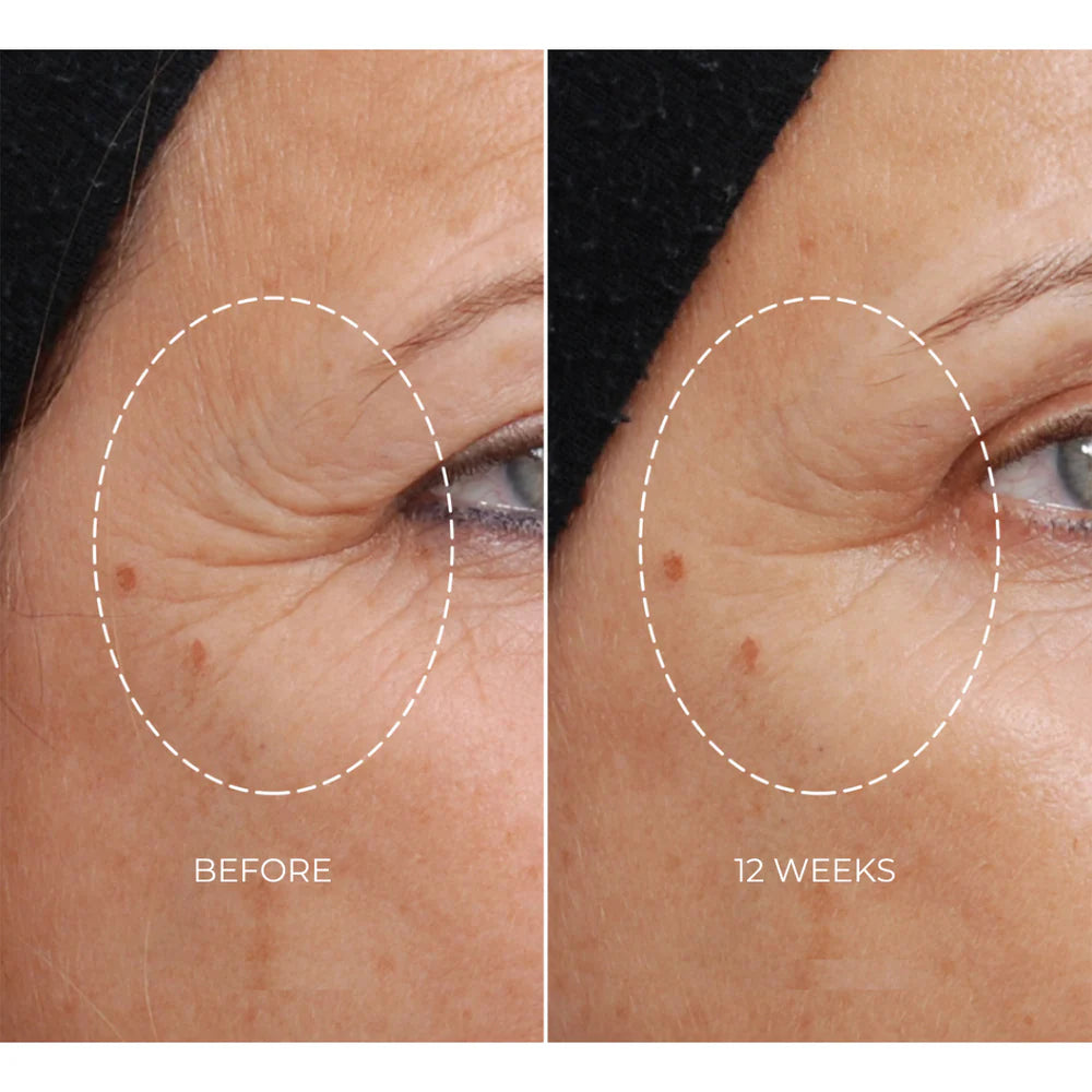 NEWA Classic Corded RF Wrinkle Reduction Device