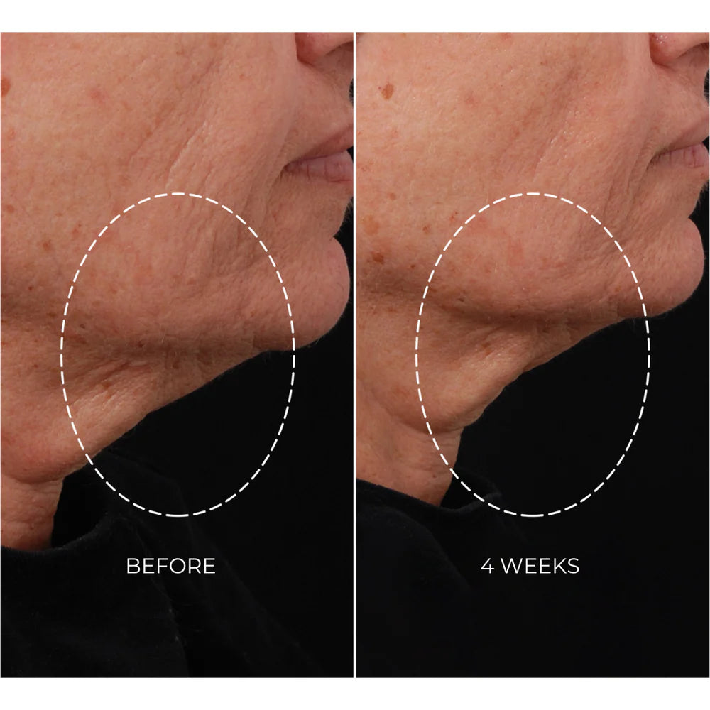 NEWA Classic Corded RF Wrinkle Reduction Device