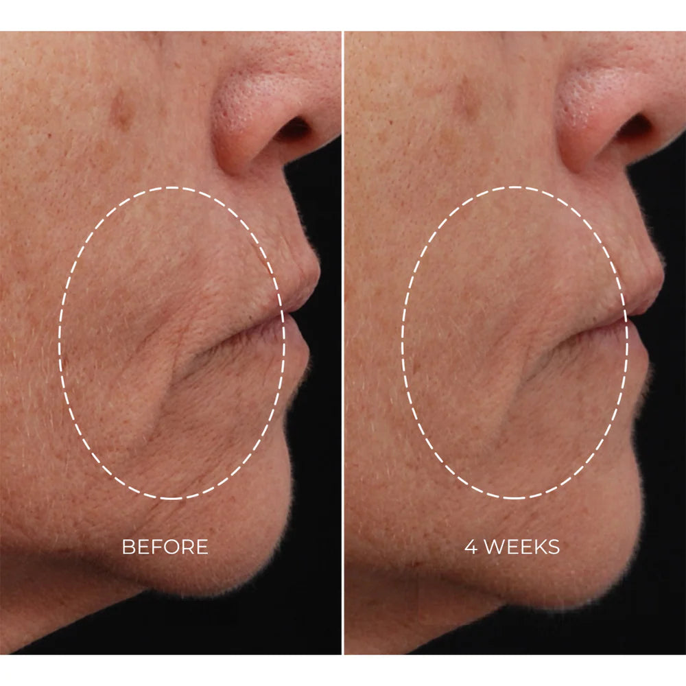 NEWA Classic Corded RF Wrinkle Reduction Device