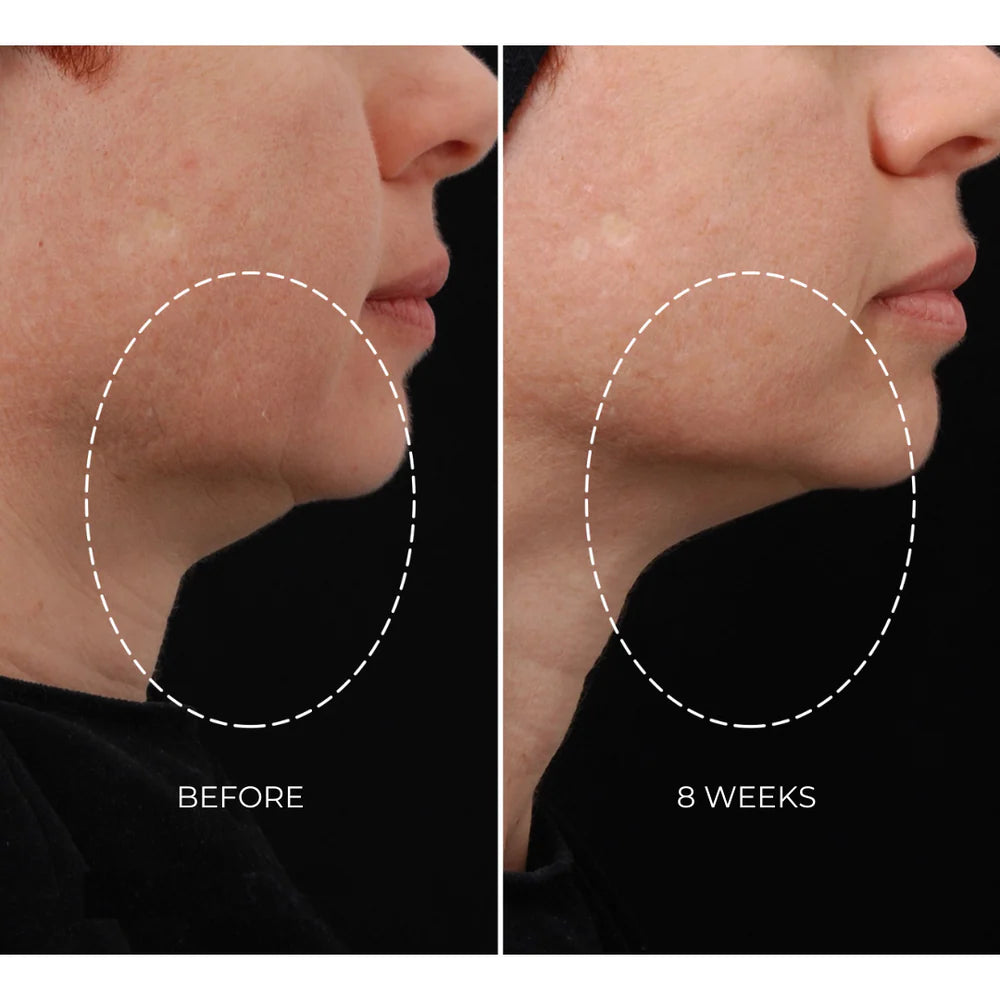 NEWA Classic Corded RF Wrinkle Reduction Device