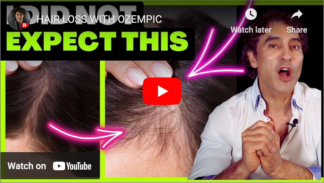 HAIR LOSS WITH OZEMPIC