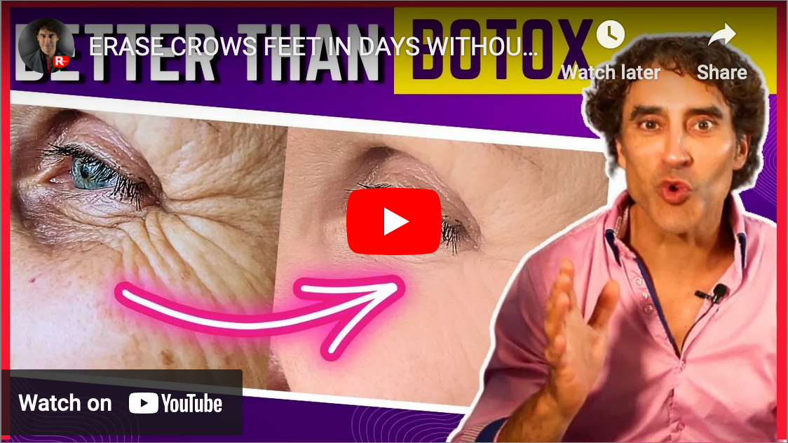 ERASE CROWS FEET IN DAYS WITHOUT BOTOX !!