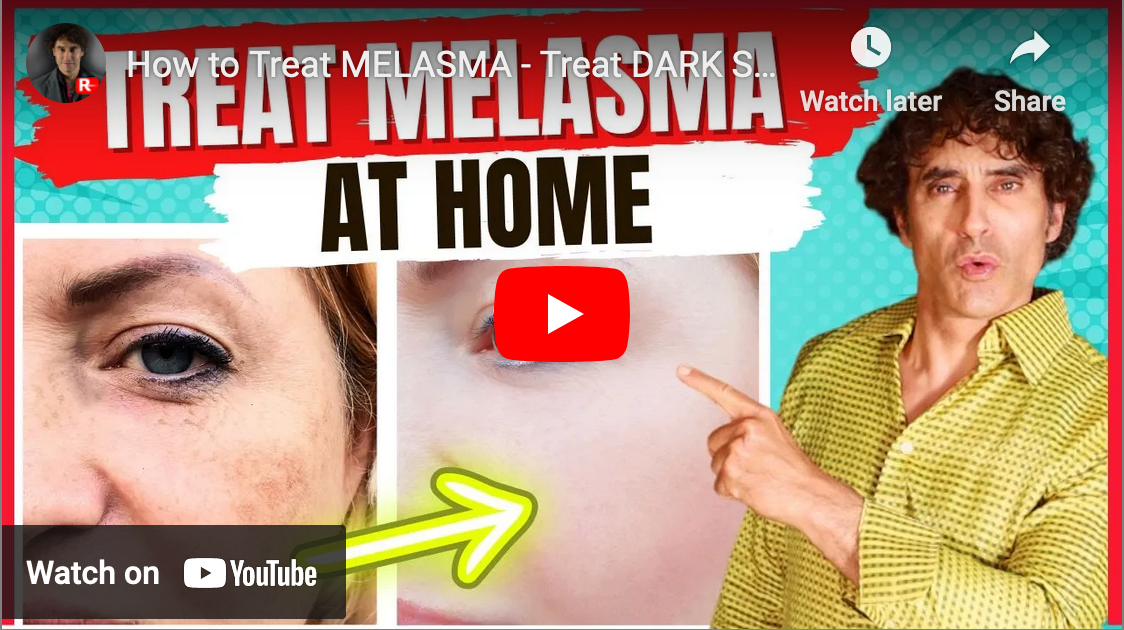 How to Treat MELASMA - Treat DARK SPOTS & PATCHES on The SKIN