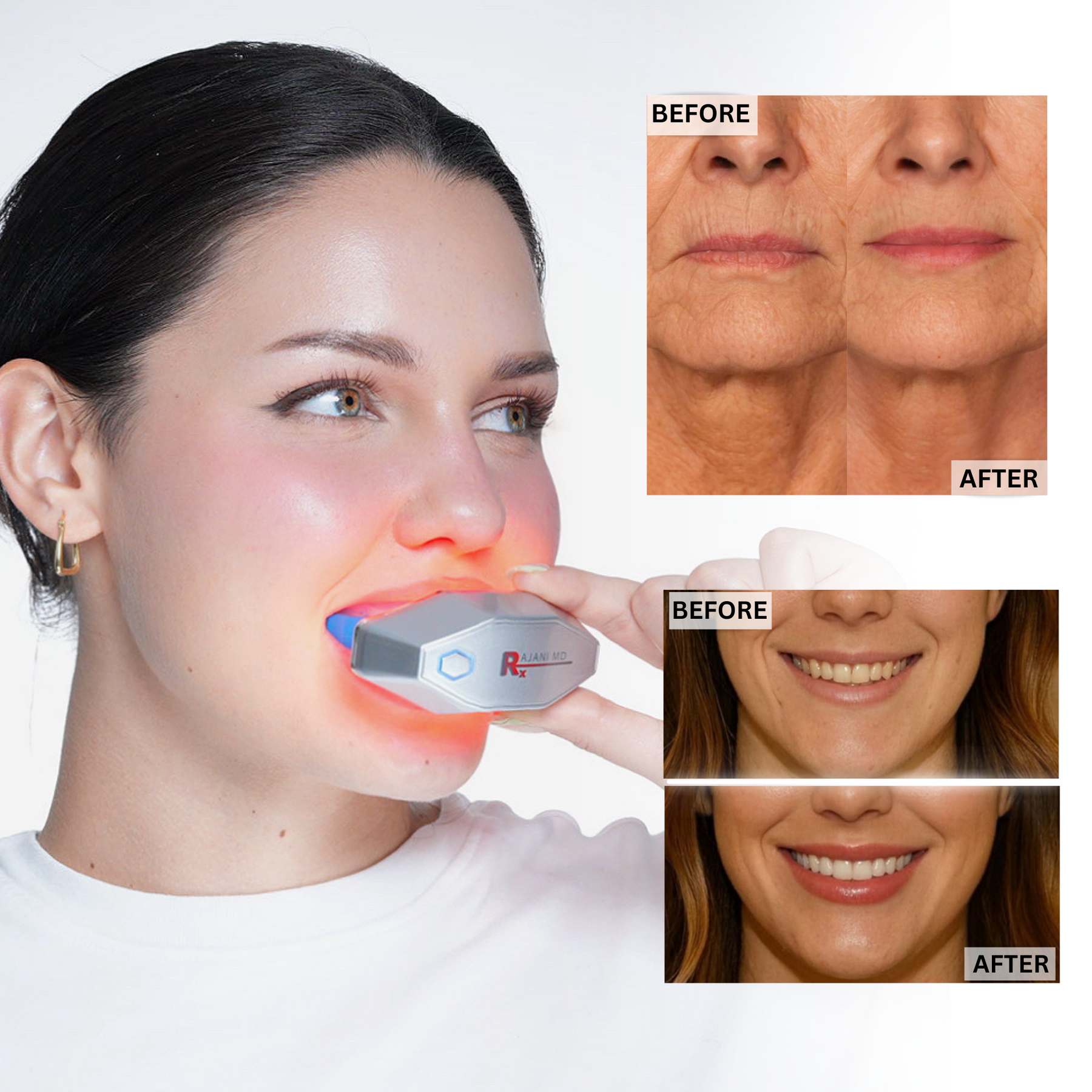 PlasmaGLO™ LED Lip and Mouth Device