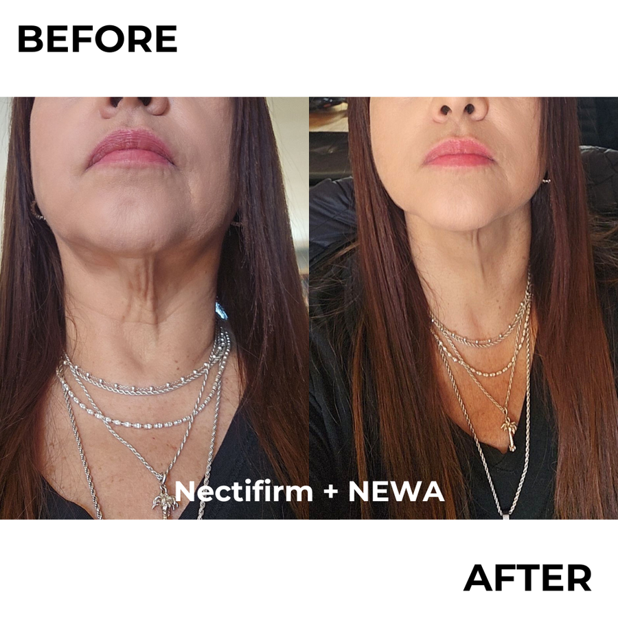 NEWA RF Device: At-Home Wrinkle Reduction & Skin Tightening