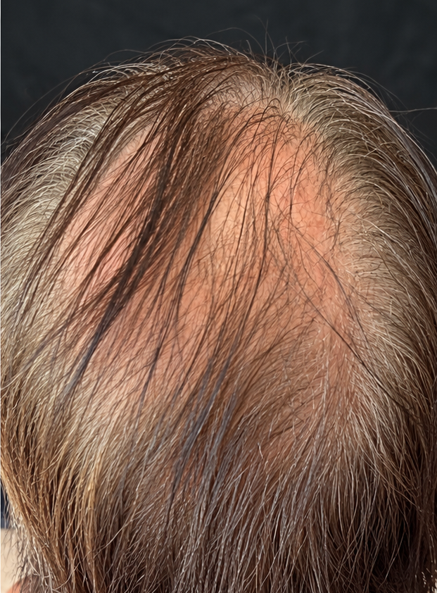 After photo showing a man’s hairline in a comparison associated with PlasmaGLO™ Hair+ Cap red light and laser therapy.