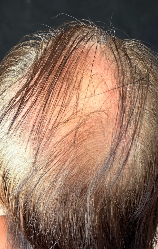 Before photo showing a man’s hairline in a comparison associated with PlasmaGLO™ Hair+ Cap red light and laser therapy.