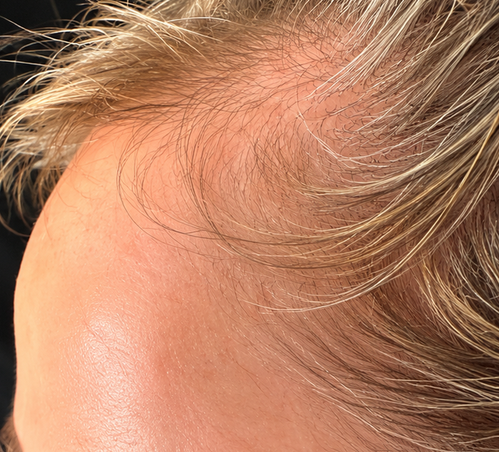Before photo of the side of the scalp in a comparison associated with PlasmaGLO™ Hair+ Cap light therapy.