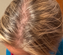 Before photo of the top of a woman’s scalp in a hair comparison associated with PlasmaGLO™ Hair+ Cap light therapy.