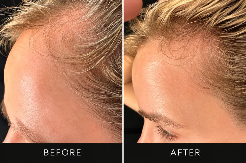 Before and after: a woman's front hairline, side view, with more coverage after