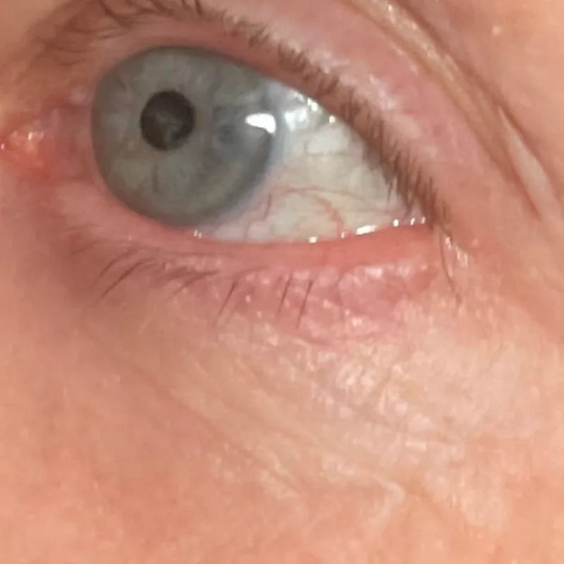 Under-eyes, after 4 weeks of use