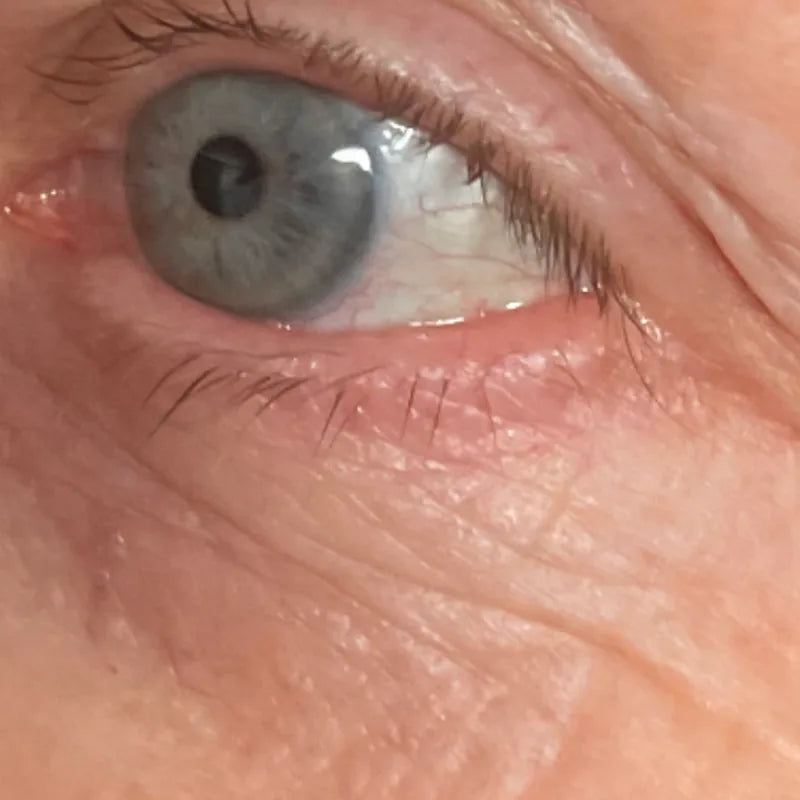 Under-eyes, before